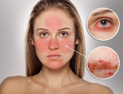 A problemática da Rosácea